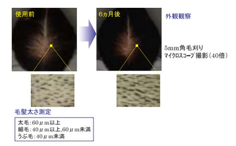 アデノシンの育毛効果の写真（資生堂によるアデノシンの臨床試験）