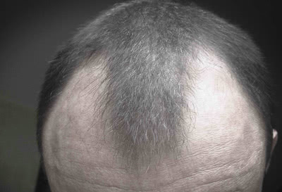 男性型脱毛症（AGA）のM字ハゲのヘアライン