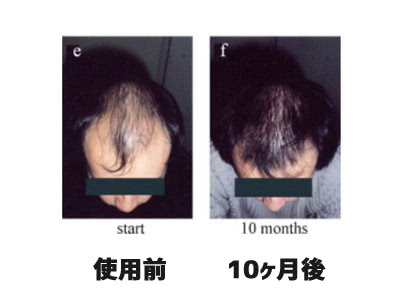 ニゾラールローション2%で男性型脱毛症（AGA）が改善した男性の症例写真