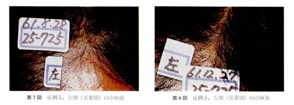 オレアノール酸の育毛効果の写真（使用前後）